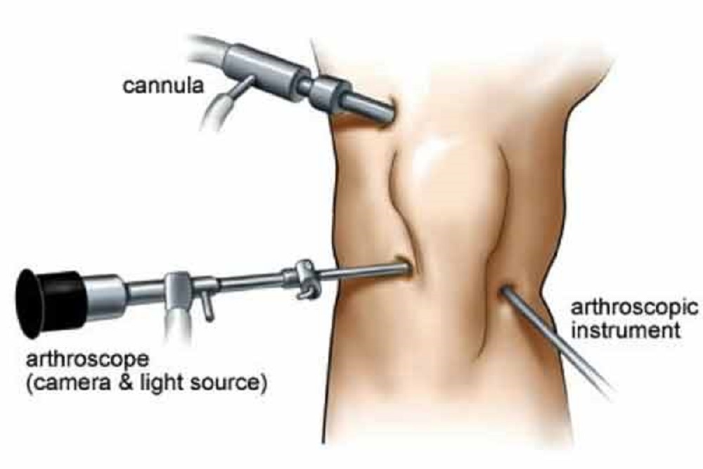 Knee Ligament Operation or Arthroscopy