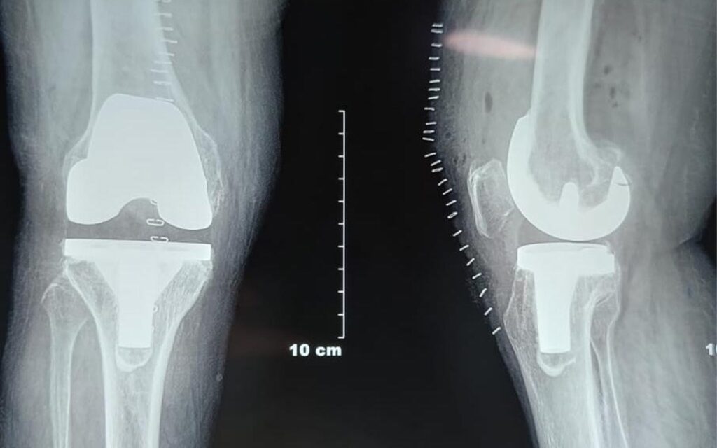 Knee Replacement Surgeon in Baner