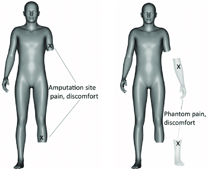 Pantom Pain Treatment in Baner