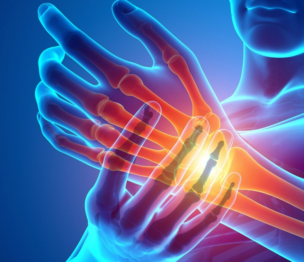 Complex Regional Pain Syndrome