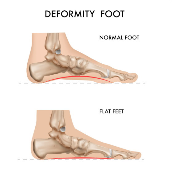 How to Correct Flat Feet: Treatment Options Available in Baner