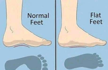 Best Insoles & Orthopedic Shoes for Flat Feet Correction in Aundh