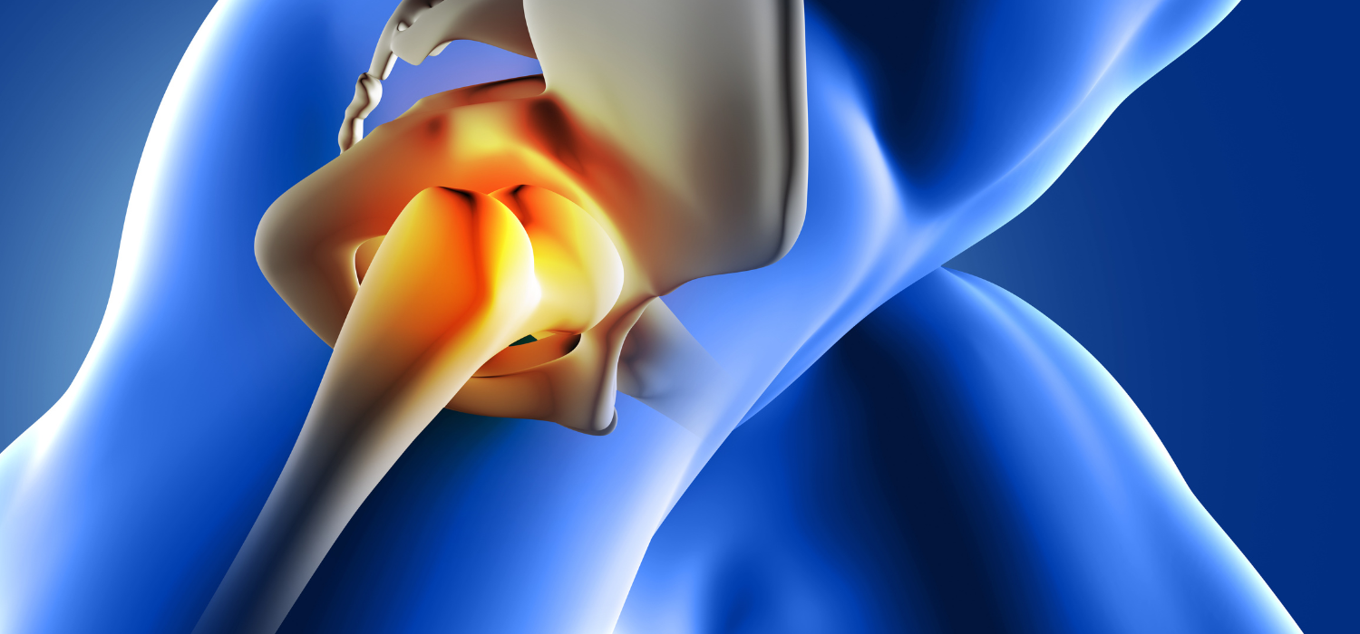 How to Prepare for Your Hip Replacement Surgery in Aundh