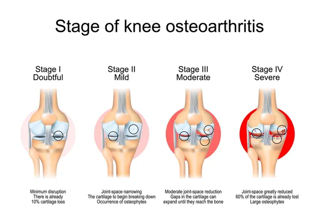 Total Knee Replacement vs Partial Knee Replacement for Knee Pain Treatment in Baner
